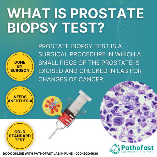 Prostate Biopsy Test - The gold standard and best test for prostate cancer diagnosis