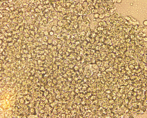 Urine pus cells as seen under the microscope Pus Cells in Urine - Microscopy