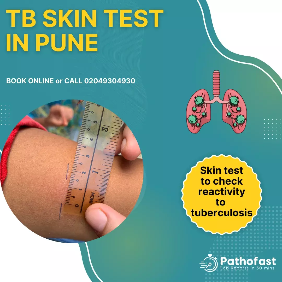 TB Skin Test in Pune - Tuberculin Skin Test